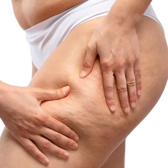 Cellulite on the thighs